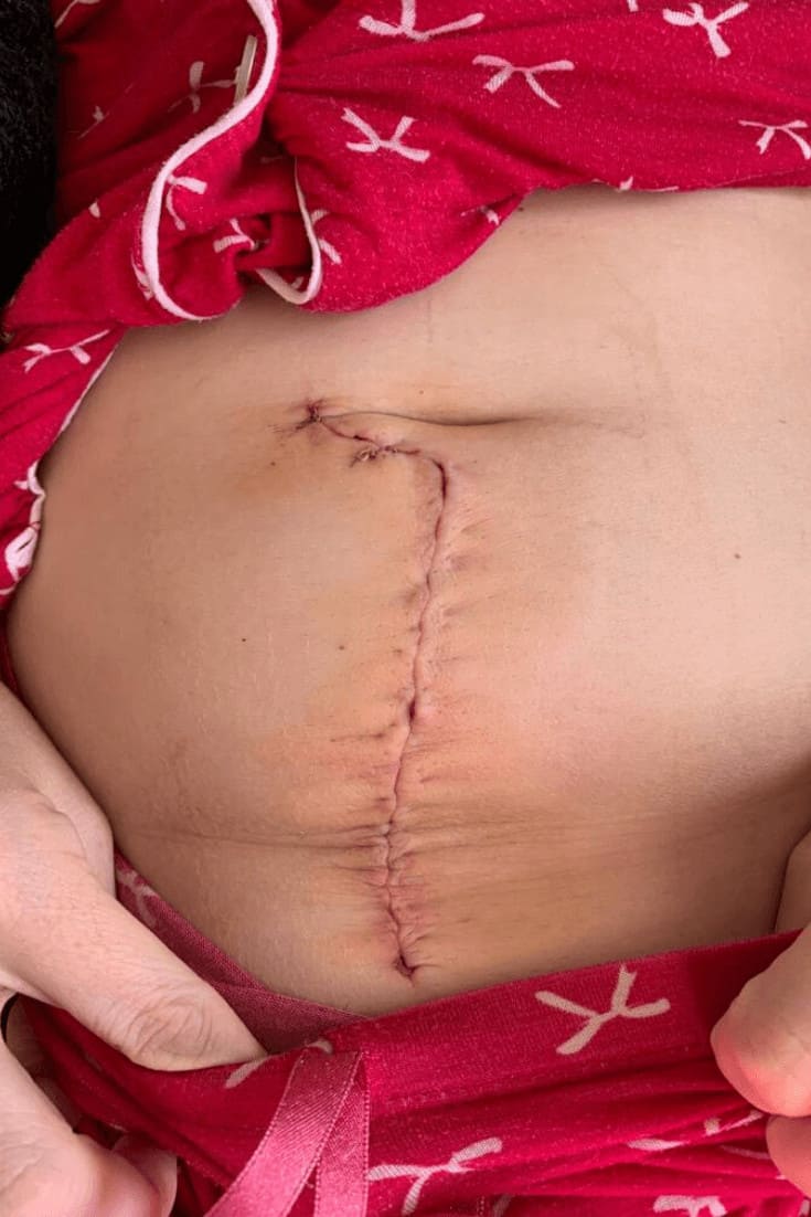 Myomectomy Scar