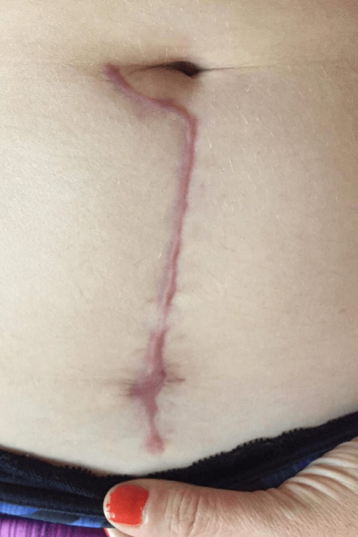 Myomectomy Scar