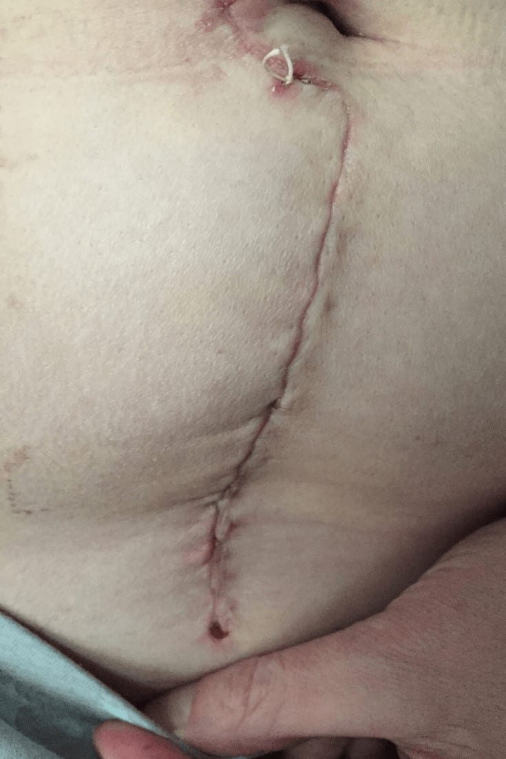 Myomectomy Scar